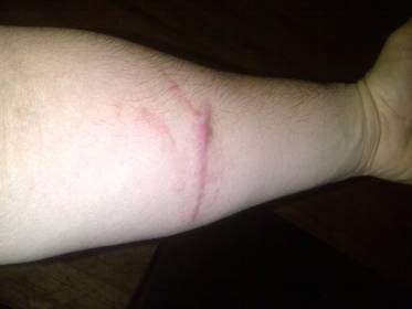 photo of forearm scar Optimized